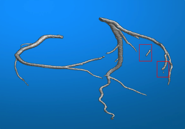 Disconnected arteries from predicted output